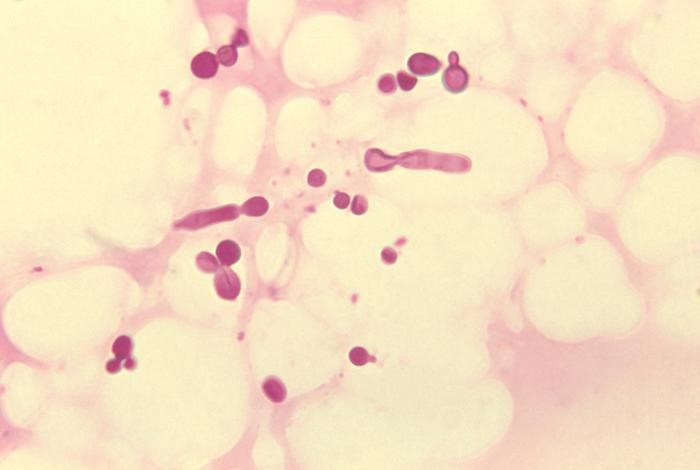 Malassezia Globosa Vulvar Infection - CDC