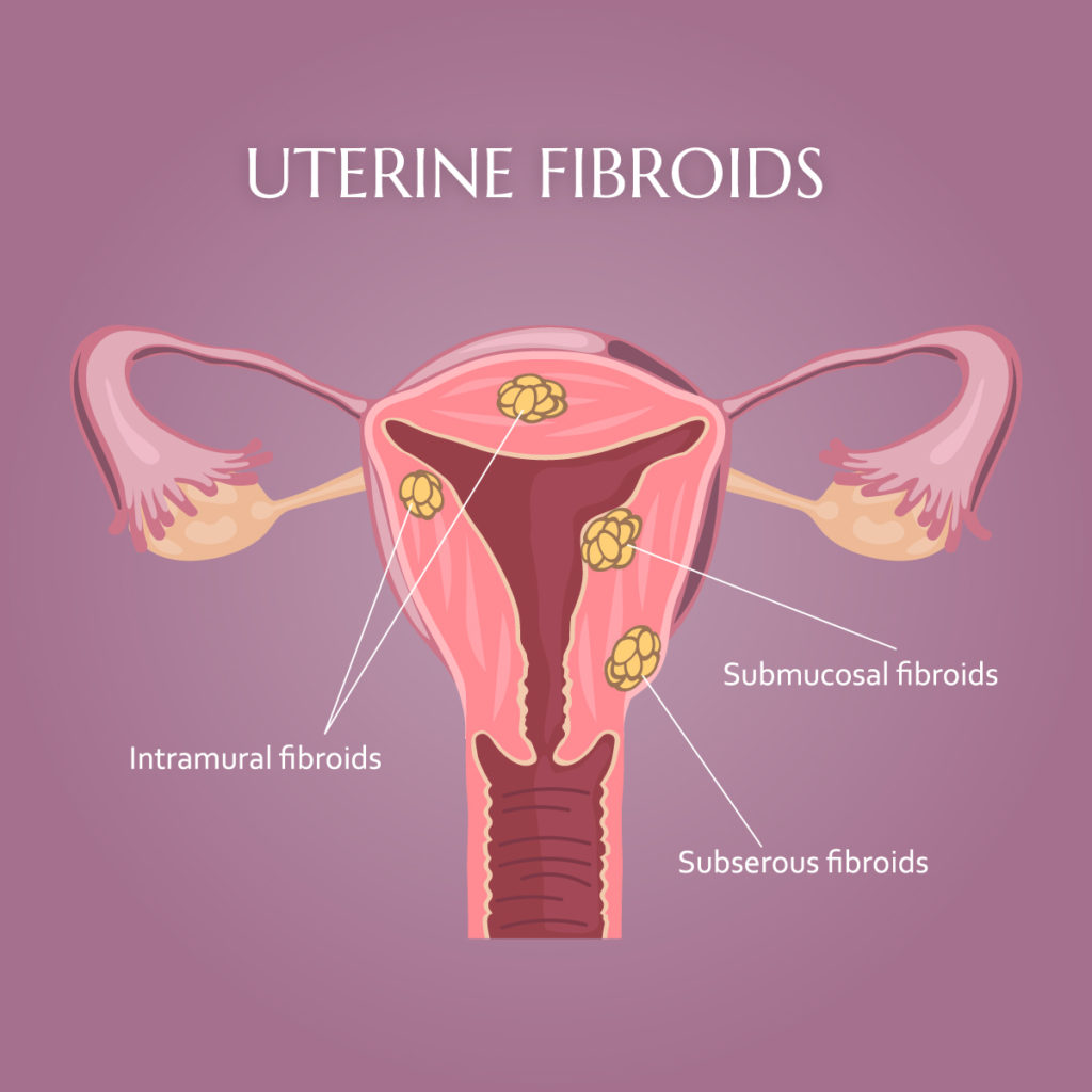 what is uterine fibroids