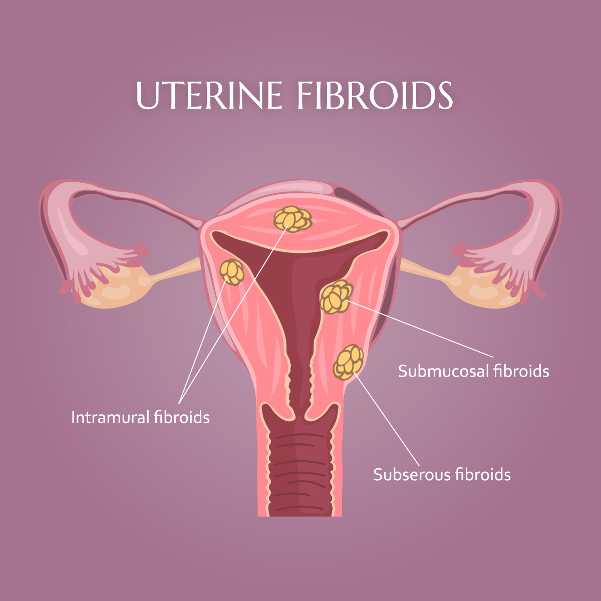 Chapter 2 – Uterine Fibroids – Melaka Fertility, image size:1200x1200