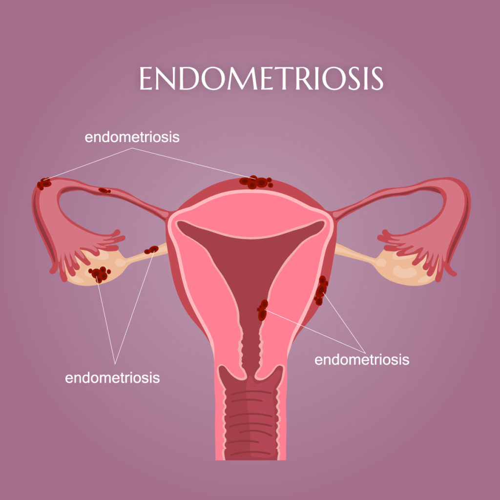 Why Is Raising Awareness Of Endometriosis Important?