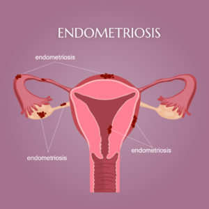 Endometriosis