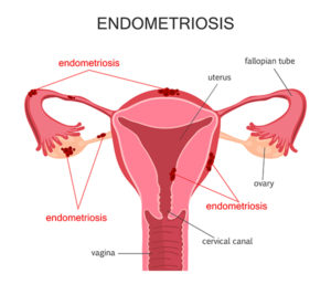 Endometriosis Diagram