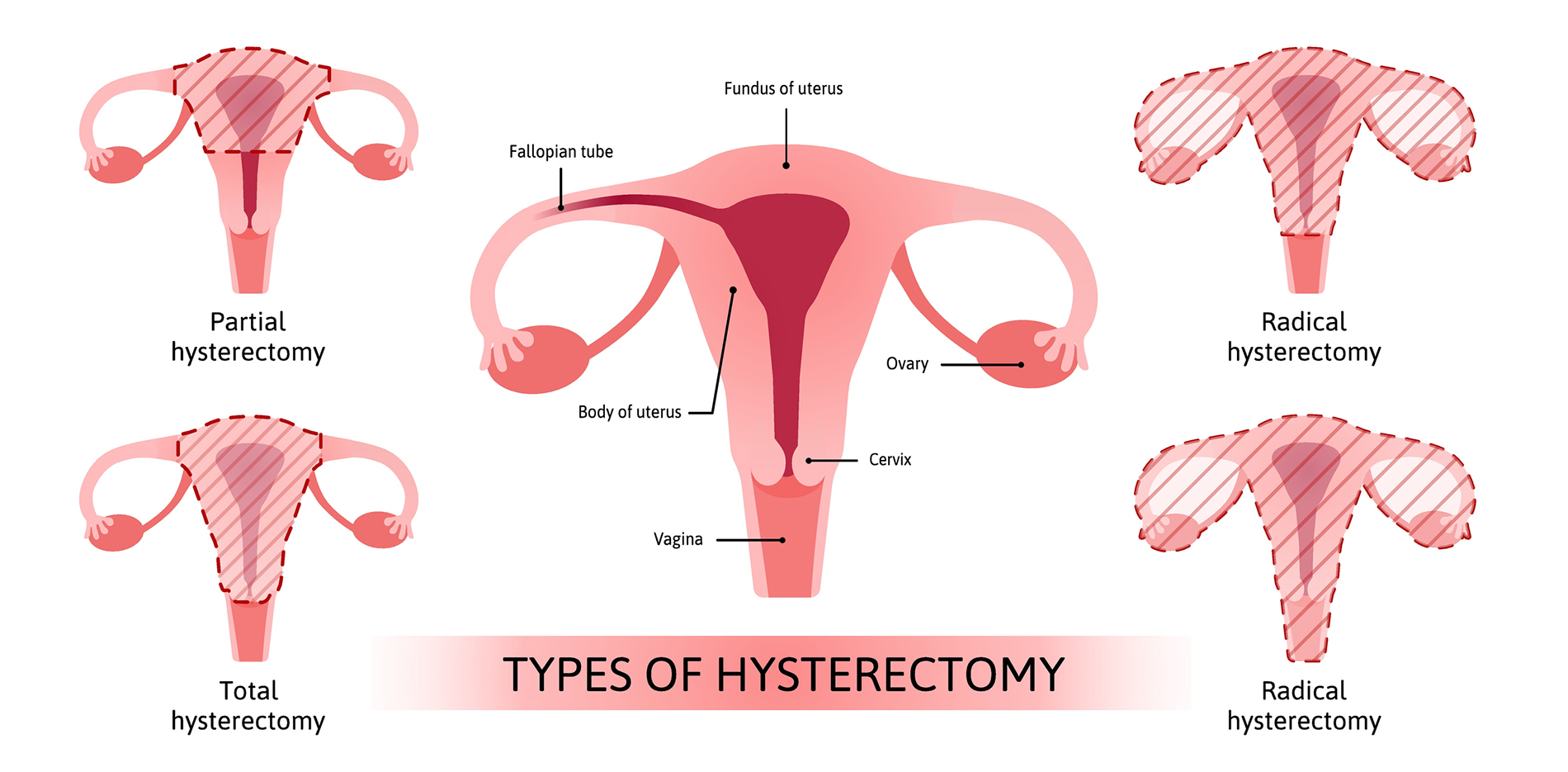 Different Types of Hysterectomy 