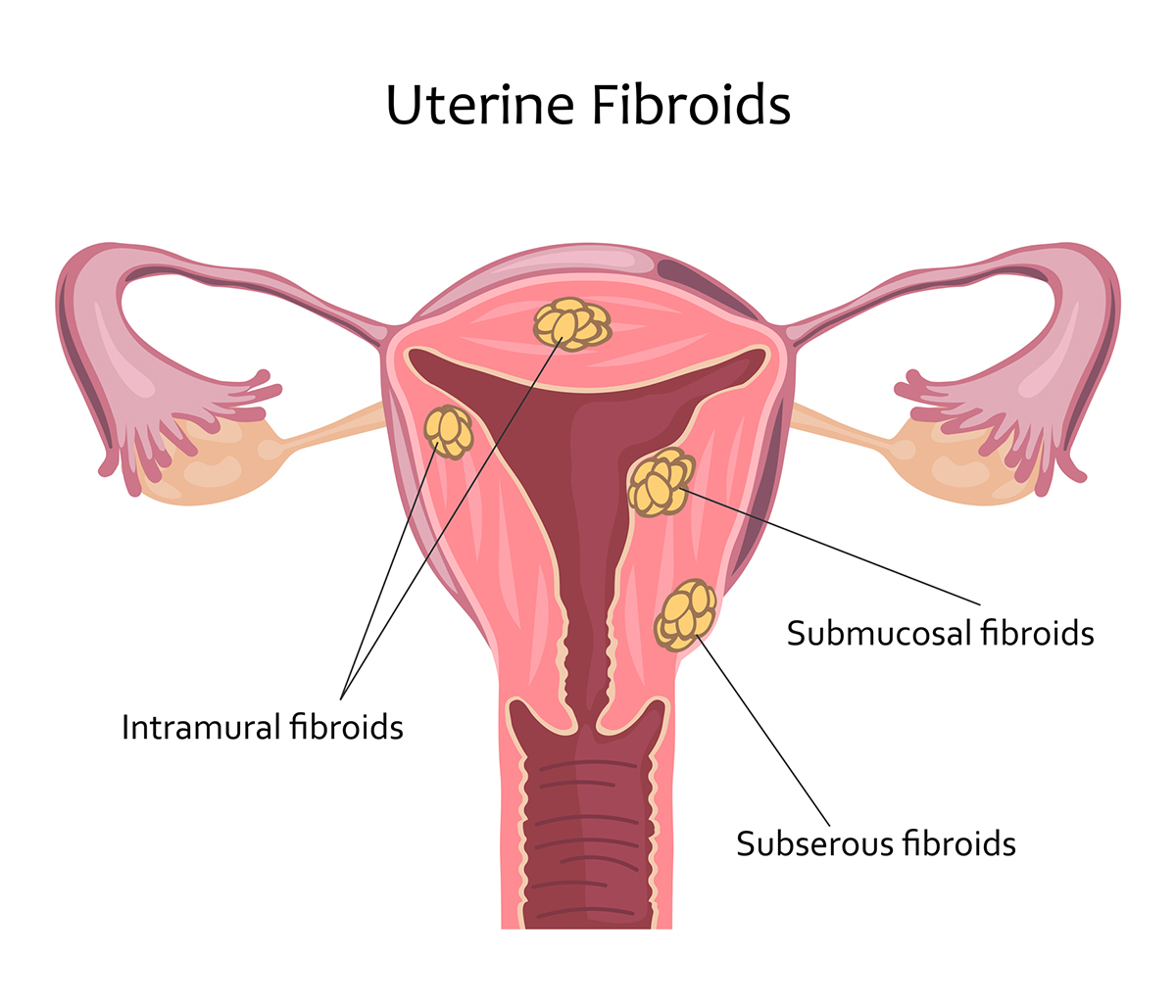 Uterine Fibroids