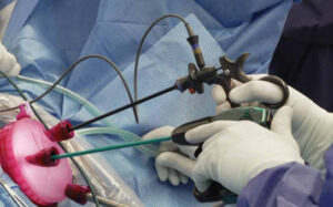 vNOTES: The Non-Invasive Hysterectomy Procedure | vNOTES