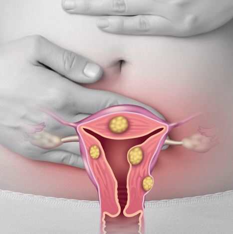 What Are Uterine Fibroids?