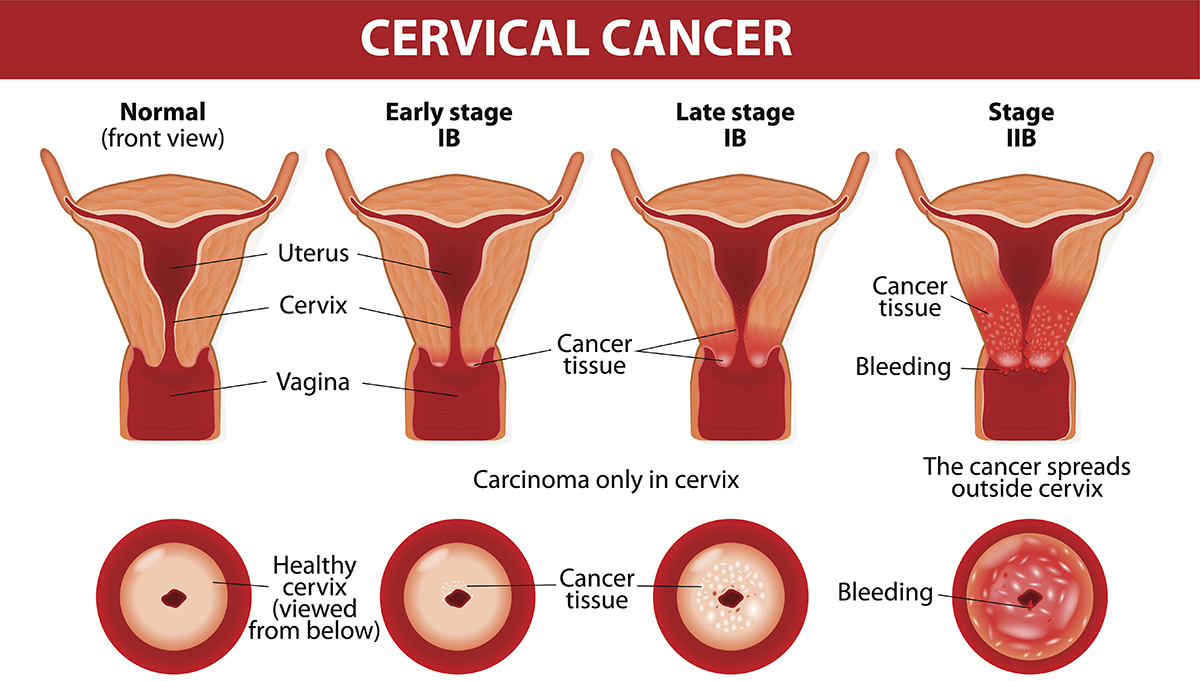 Cervical Cancer