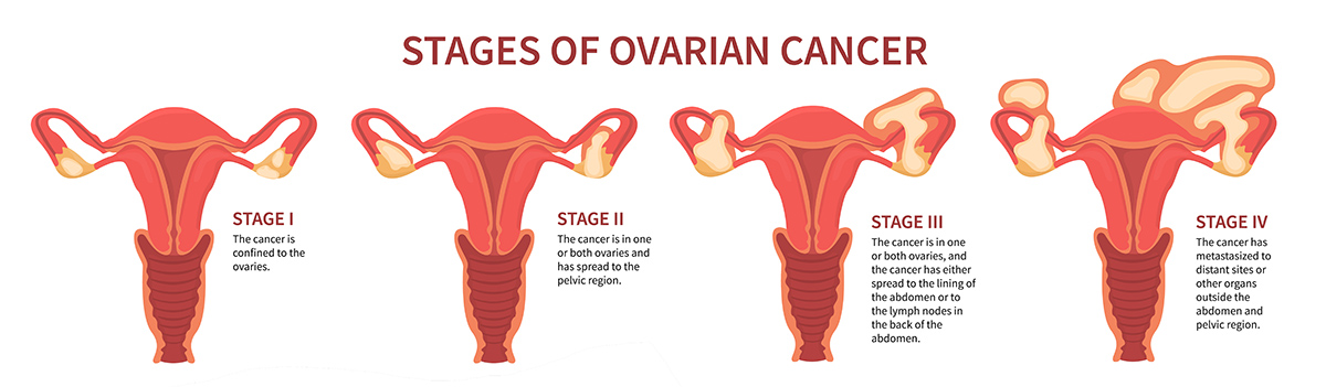 ovarian cancer 