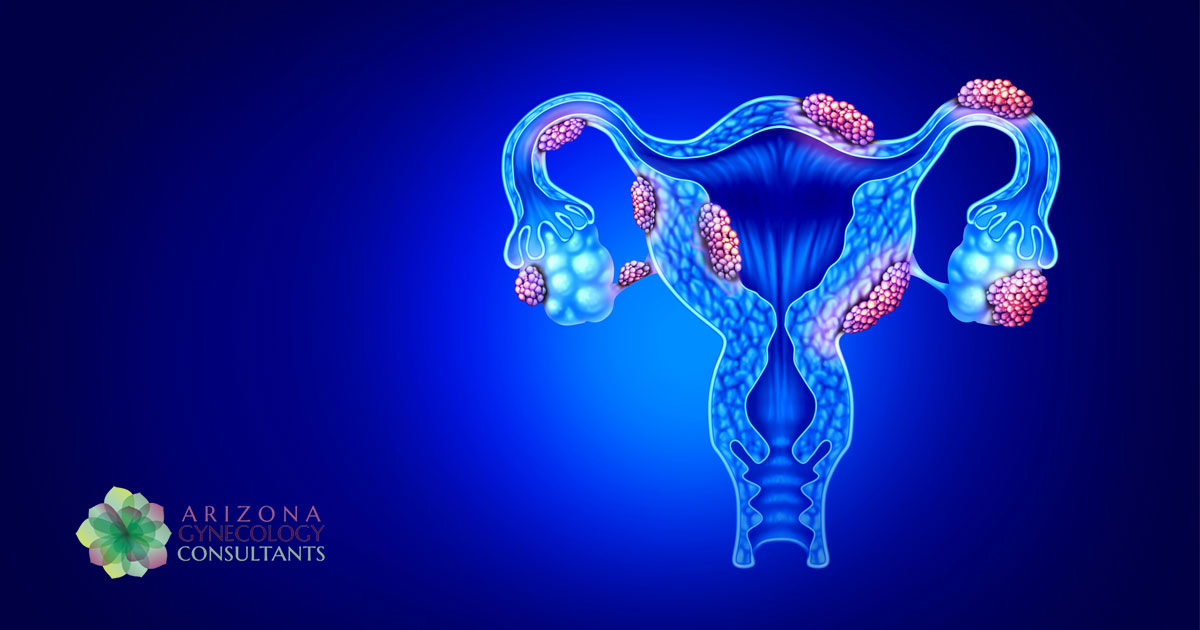 Side Effects of Untreated Uterine Fibroids
