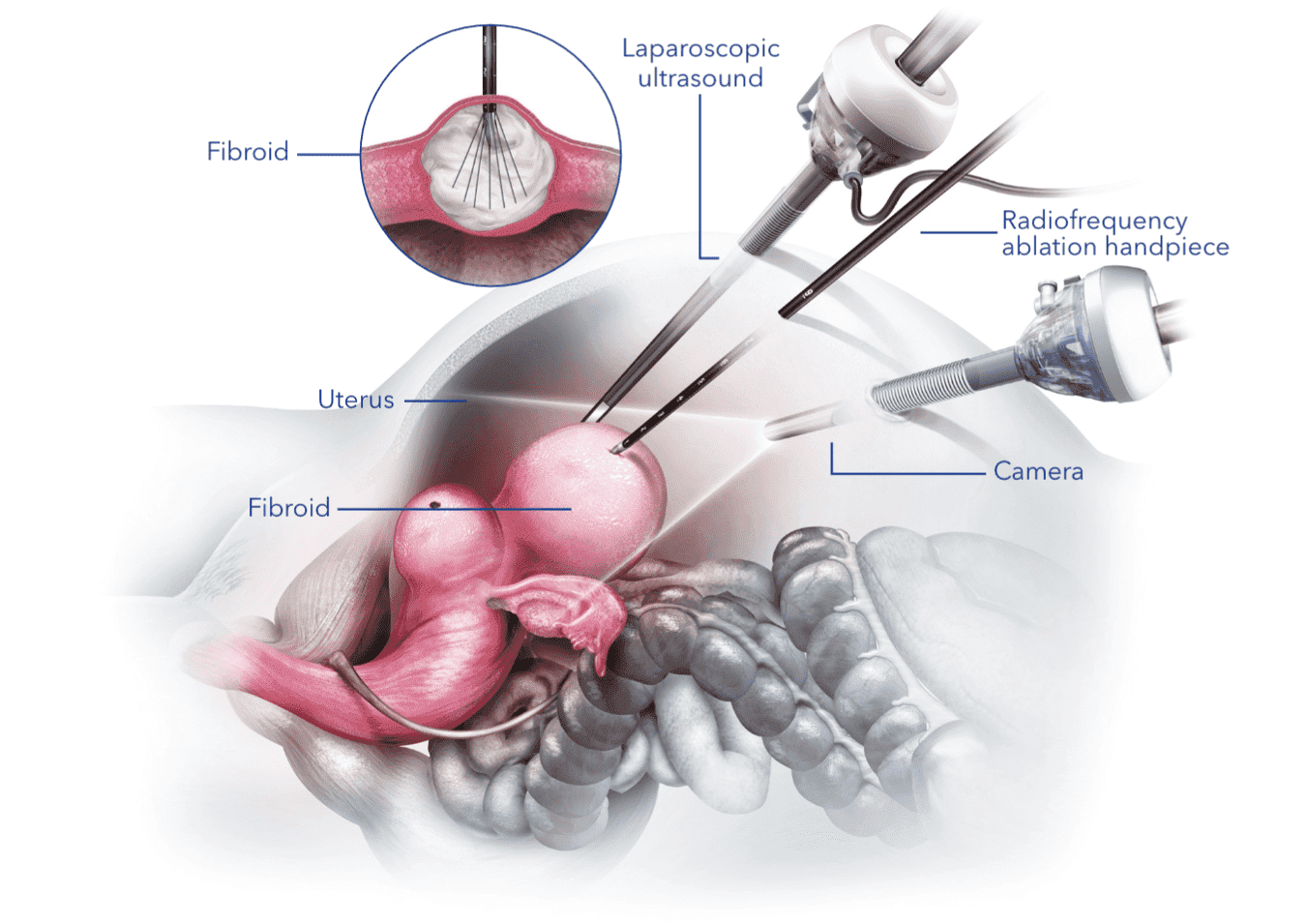 ACESSA procedure