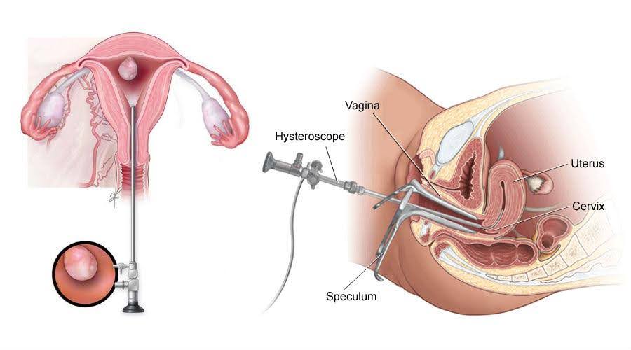 Hysteroscopic Myomectomy