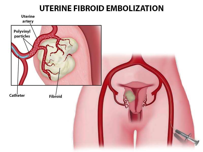 Uterine Artery Embolization