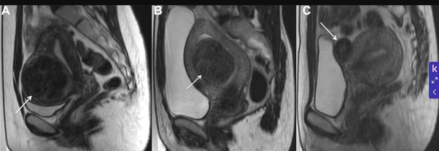 Pelvic MRI