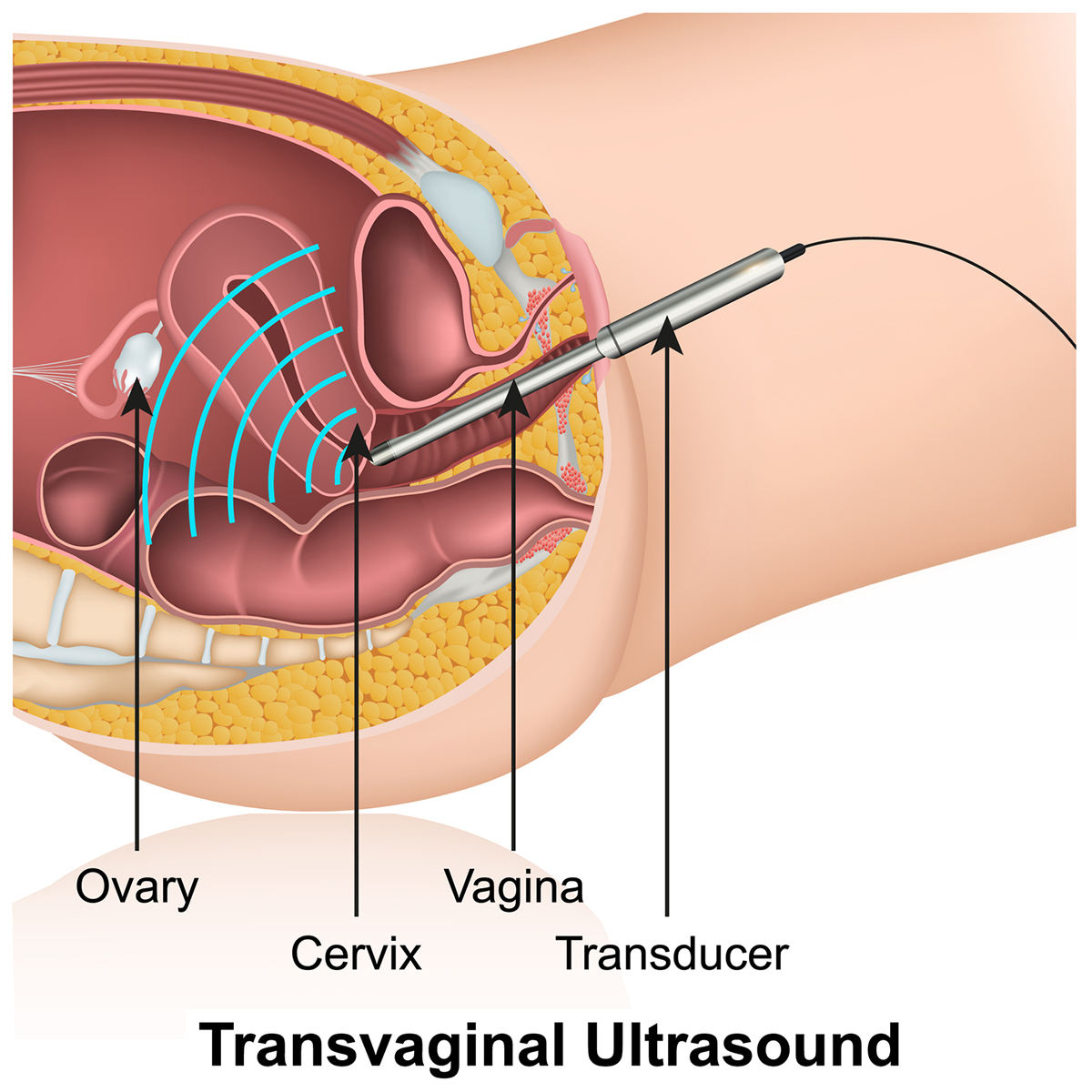 transvaginal ultrasound