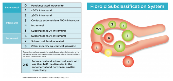 What are the different types of uterine fibroids?