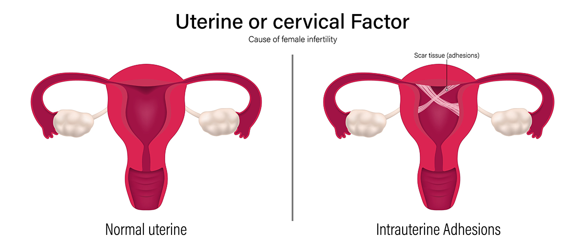 What Are Intrauterine Adhesions