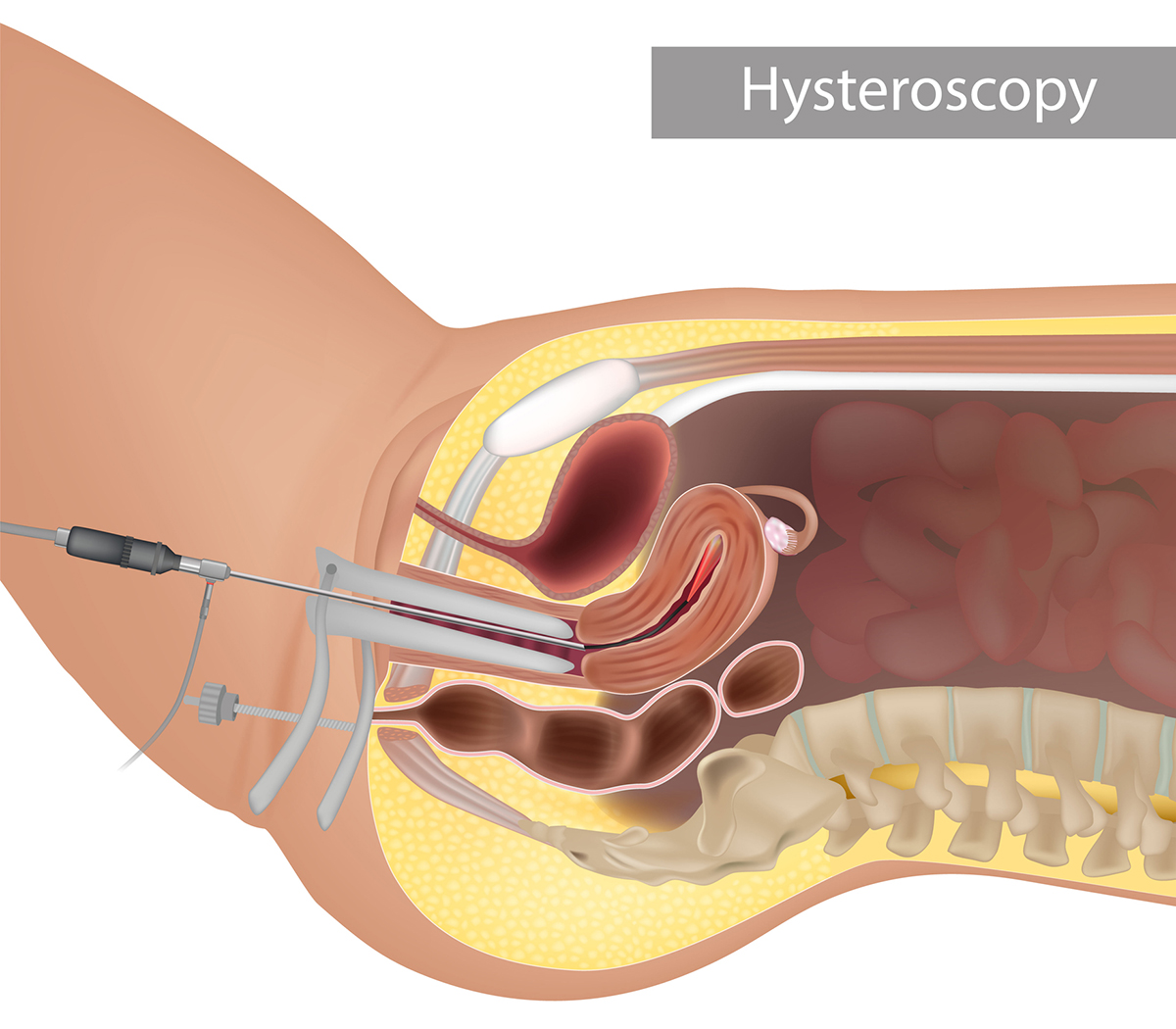 How Are Intrauterine Adhesions Diagnosed