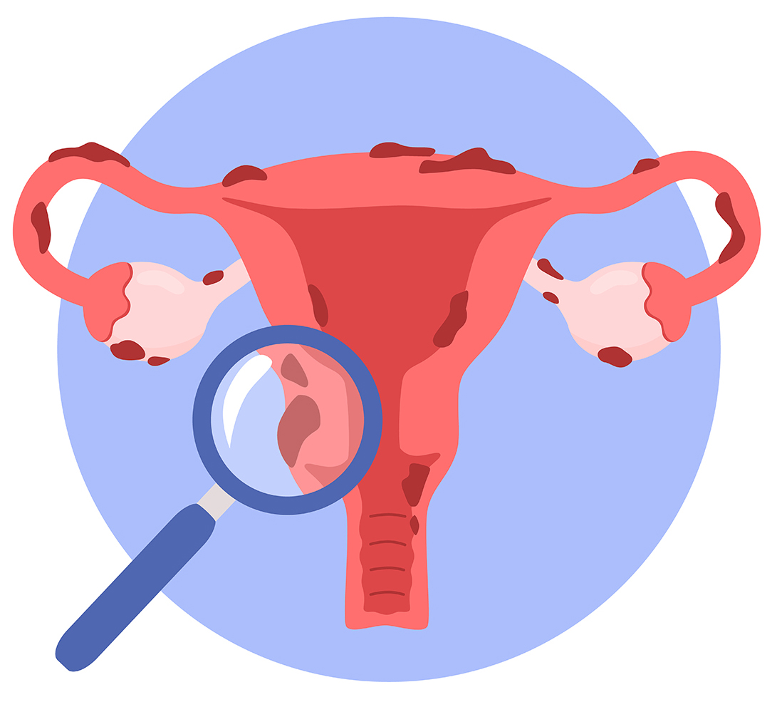 What Is Endometriosis