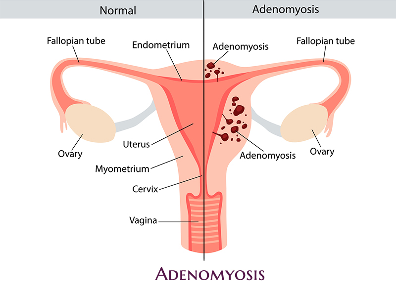 Adenomyosis