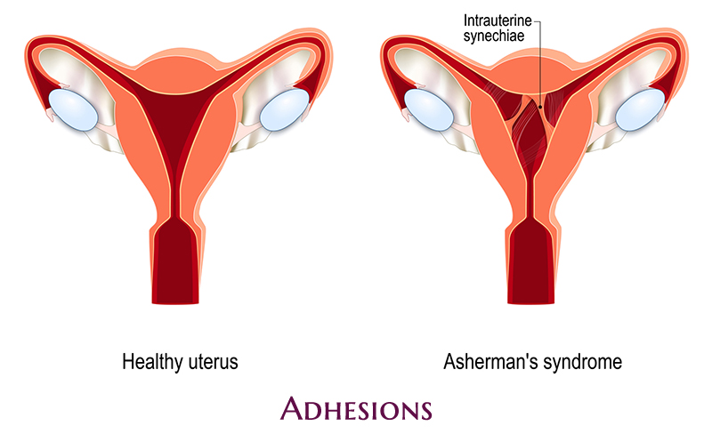 Post-Surgical Adhesions