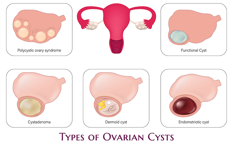 Ovarian Cysts