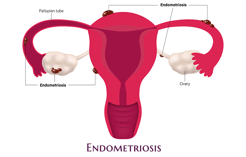 Endometriosis