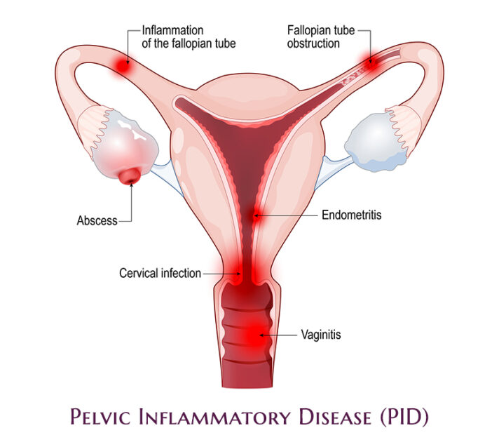 Pelvic Inflammatory Disease (PID)