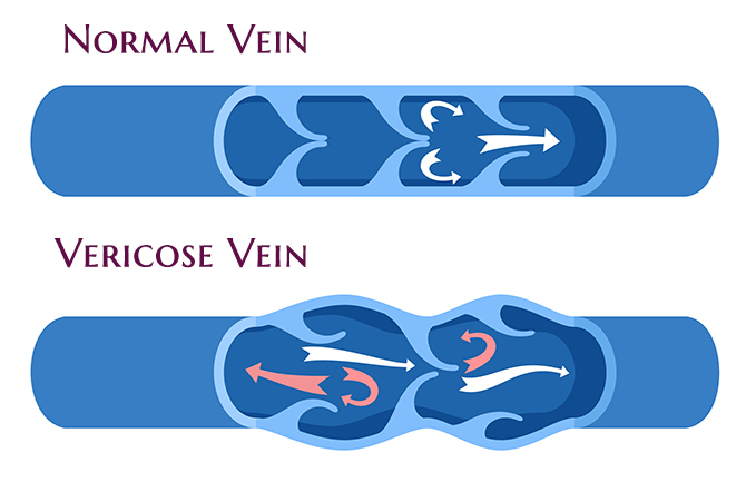 Pelvic Congestion Syndrome