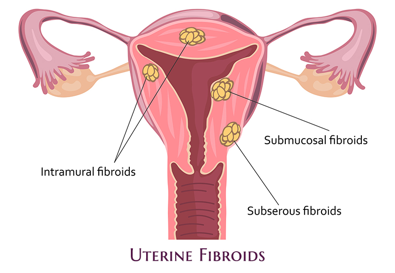 Uterine Fibroids