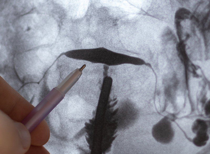 Endometriosis Imaging