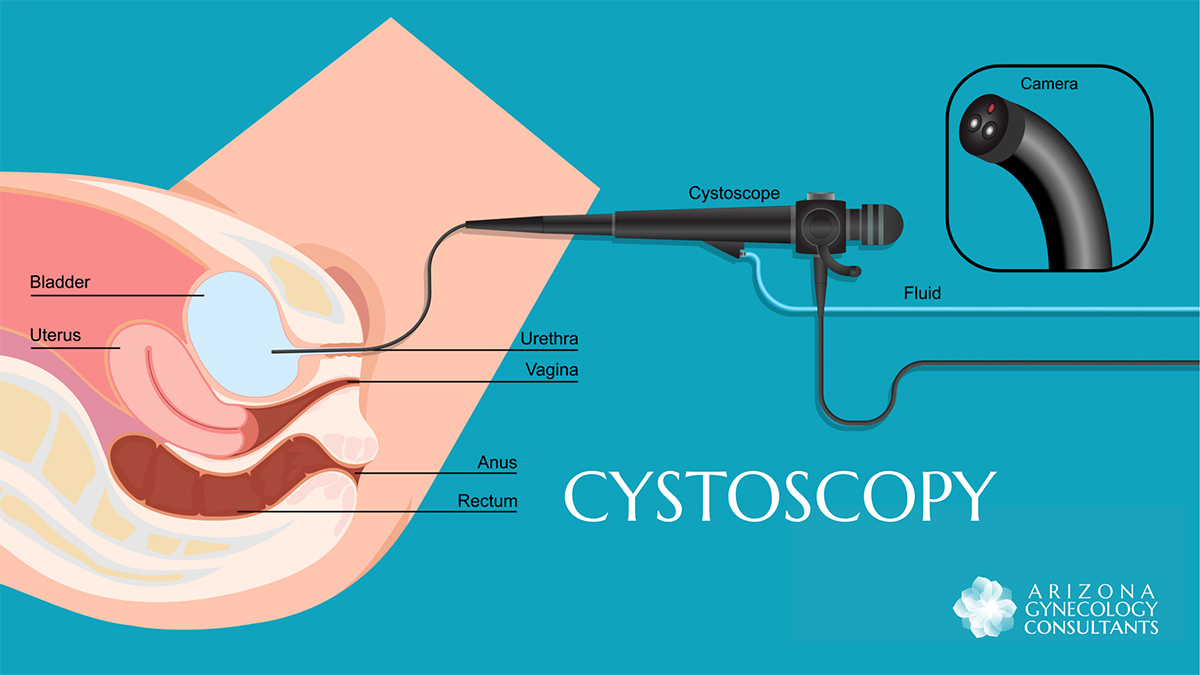 Cystoscopy may identify several issues related to the urinary tract